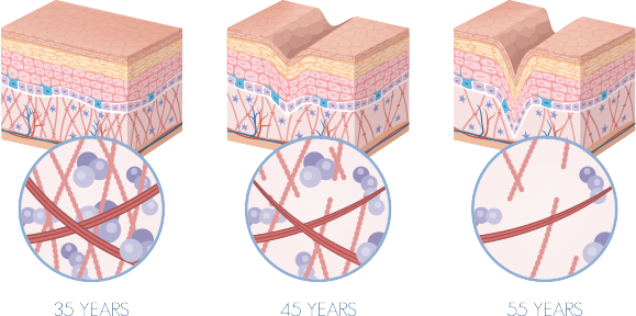 collagen-decrease